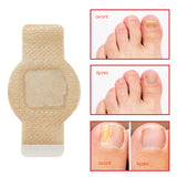 Plaques fongiques sur les ongles