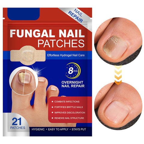 Plaques fongiques sur les ongles