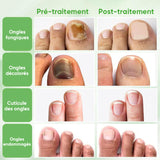 Traitement des ongles au gingembre