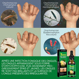 Traitement des ongles au gingembre