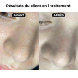 Kit de Traitement des Comédons