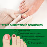 Traitement des ongles au gingembre
