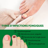 Traitement des ongles au gingembre
