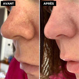 Kit de Traitement des Comédons