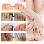 Plaques fongiques sur les ongles