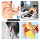 Wi-Fi Visible Wax Elimination Spoon, USB HD Load Otoscope